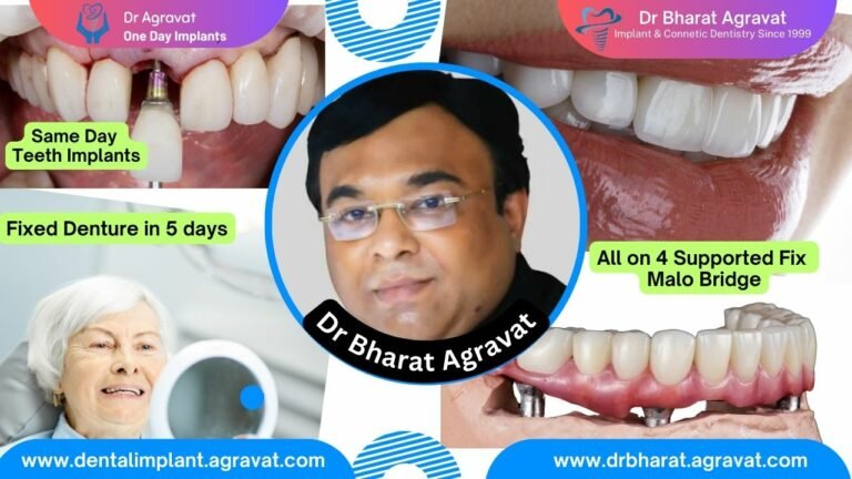 Best Dentist for Full Mouth Dental Implants Clinic in Ahmedabad: Dr. Bharat Agravat, the top Implantologist.